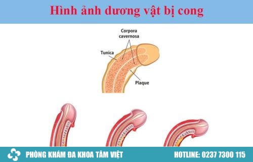 Hình ảnh dương vật cong thường gặp ở nam giới